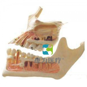 “康為醫(yī)療”牙體病變模型