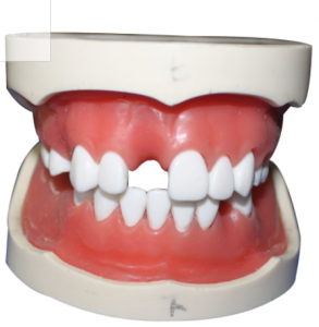 種植牙模型（含上、下頜）
